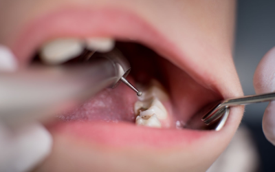 5 Ways to Fight Tooth Decay This New Year