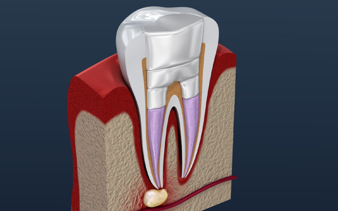 Common Signs You Need a Root Canal