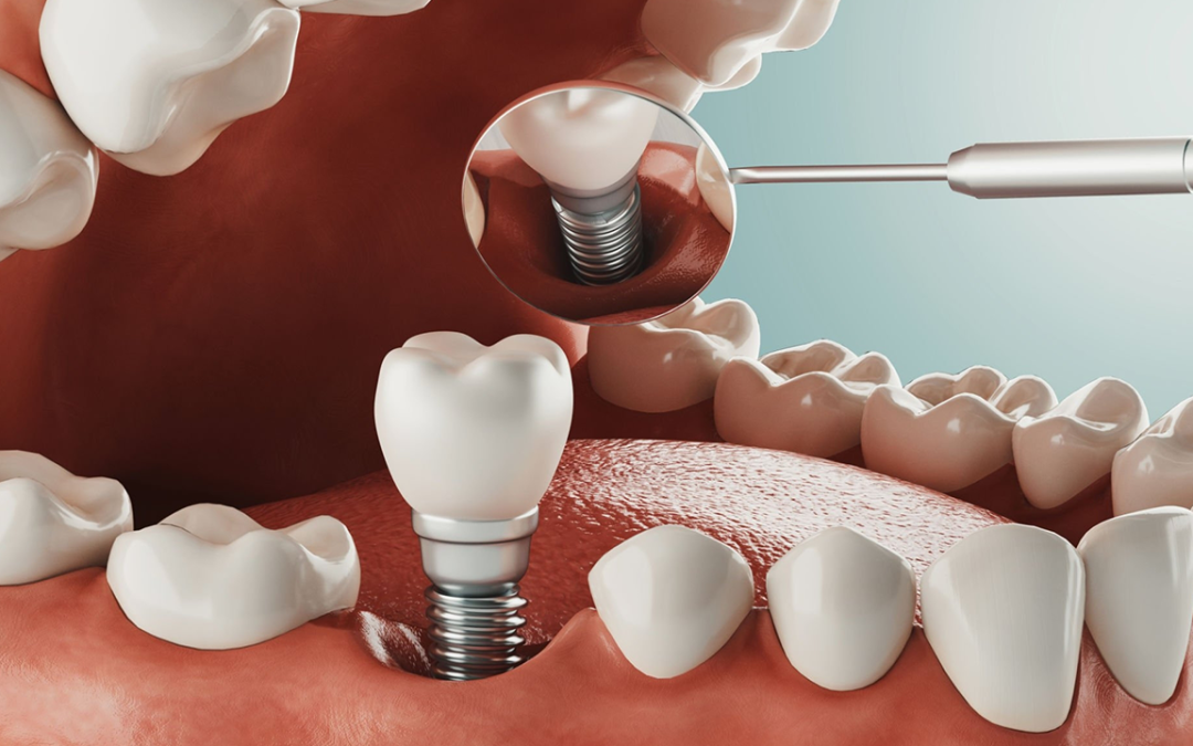 Reasons Why You Should Opt For A Dental Implant
