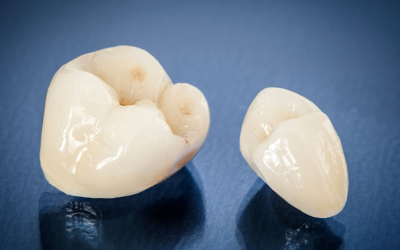 What To Expect From a Dental Crown