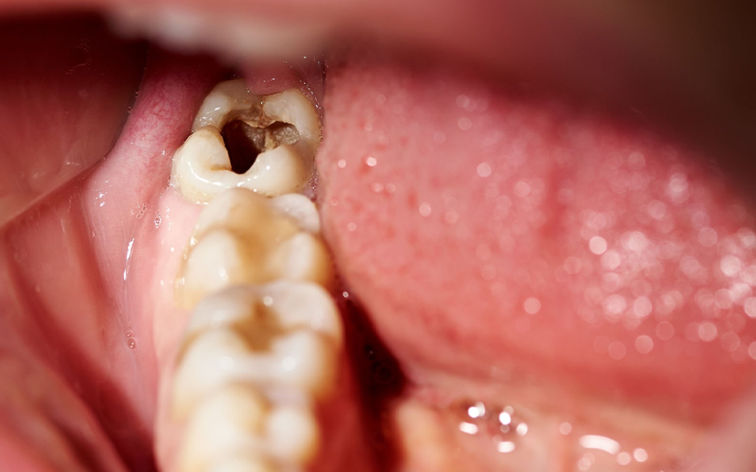 Most Common Signs Of Tooth Decay