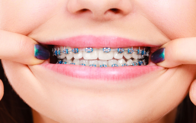 The Medical Benefits of Braces