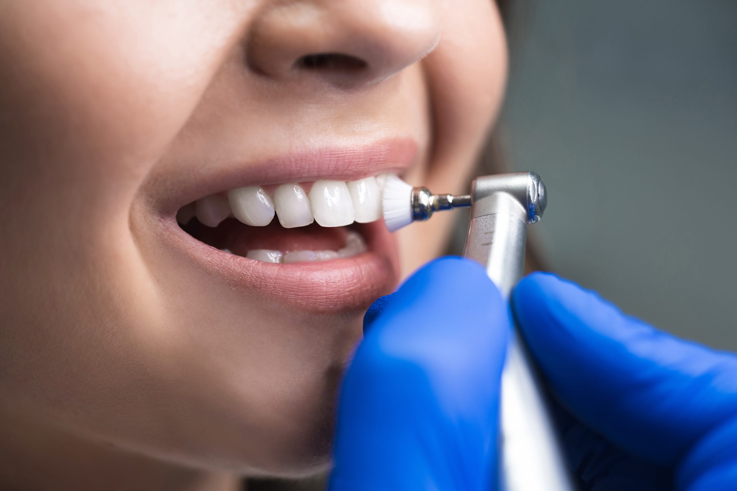 Process of using stomatological brush as a stage of professional dental cleaning procedure in clinic close up