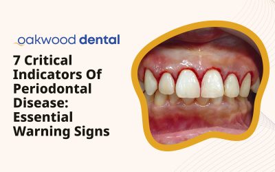 7 Critical Indicators of Periodontal Disease: Essential Warning Signs